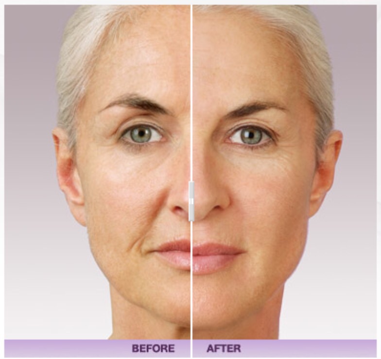 juvederm fillers before and after
